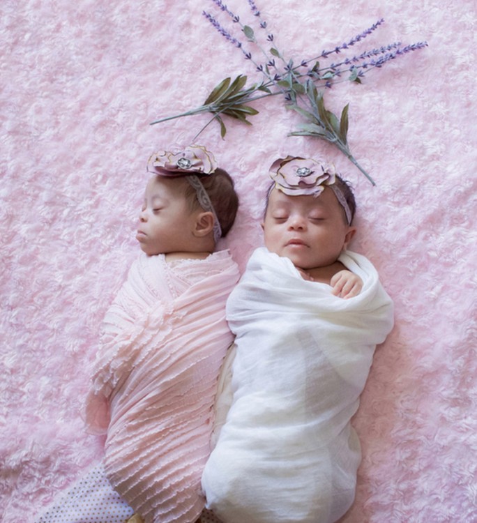 Foto de Laura Duggleby das gêmeas com síndrome de Down. As gêmeas são bebês ainda e idênticas.