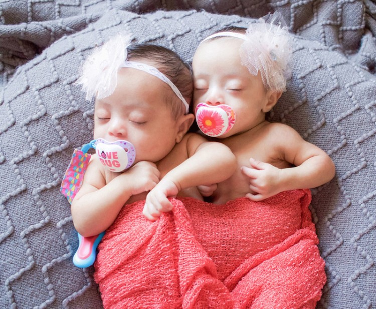 Foto de Laura Duggleby das gêmeas com síndrome de Down. As gêmeas são bebês ainda e idênticas.
